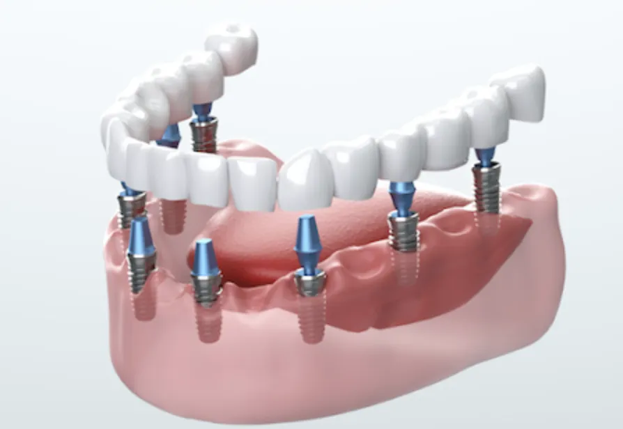 how-to-get-cheap-dental-implant