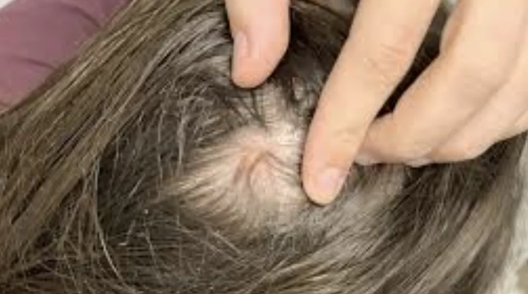 Understanding Scalp Psoriasis: Symptoms, Causes, and Treatment Options